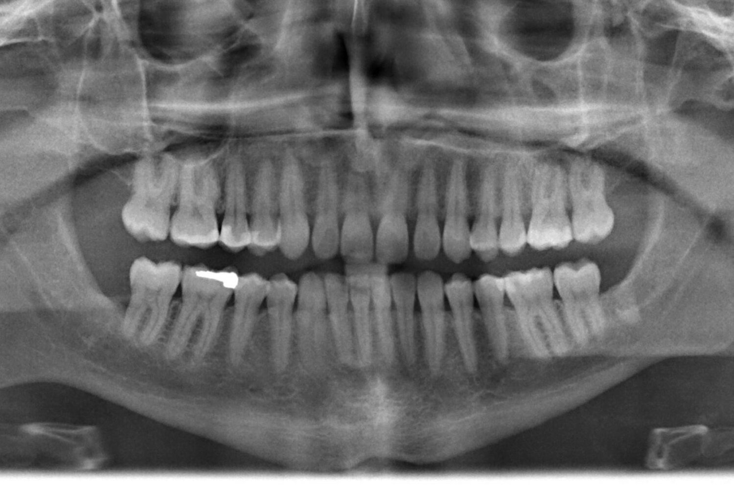 Image of a dental X-ray