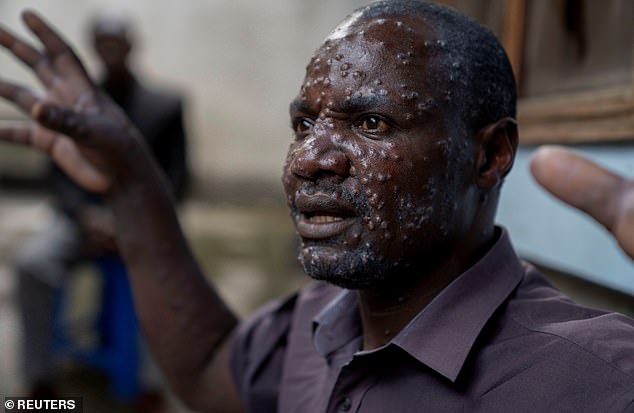 Jean Kakura Biyambo, a father of six from the Muja internally displaced persons camp in DRC, gestures from a general hospital where he has been receiving treatment for mpox, on July 16