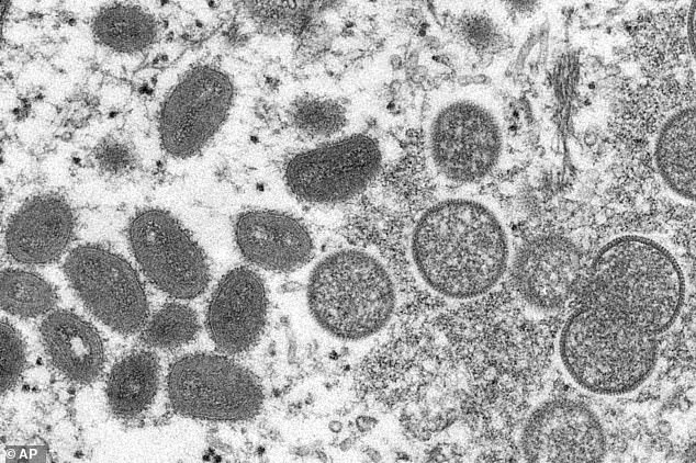 Mpox virions shown under a microscope. Experts warn the new 1b Clade is harder to detect