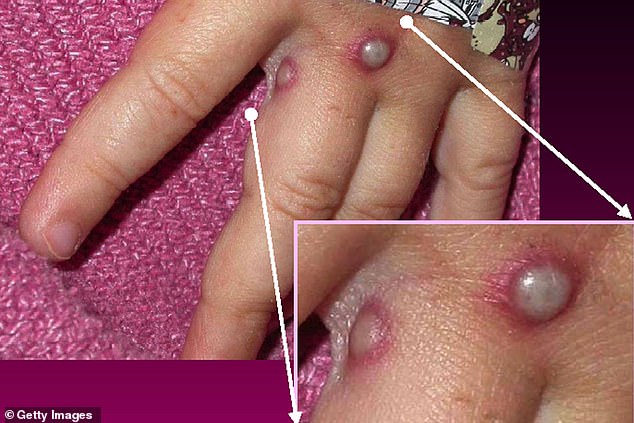 Symptoms of one of the first known cases of the mpox virus shown on a patient's hand in 2003