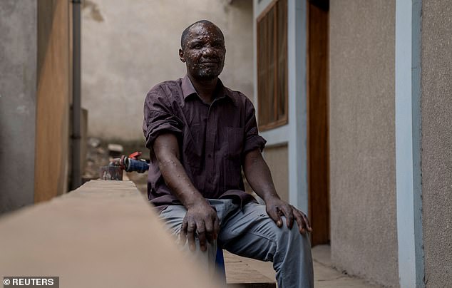 Jean Kakuru Biyambo resides at the Goma general hospital to receive treatment for mpox, 16/7