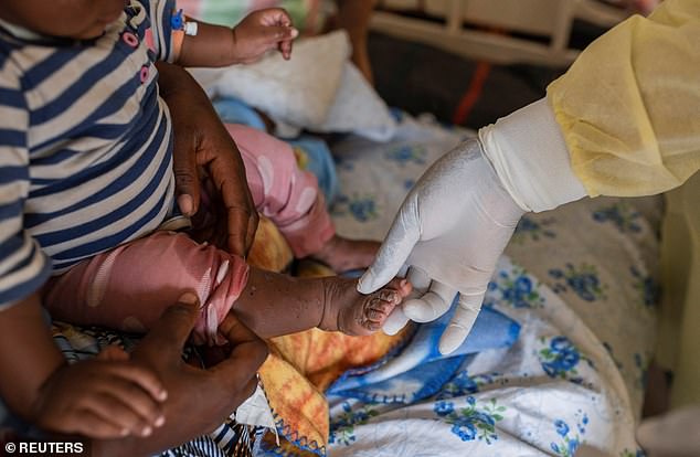 A new variant of mpox is reported to be more deadly in children and harder to detect