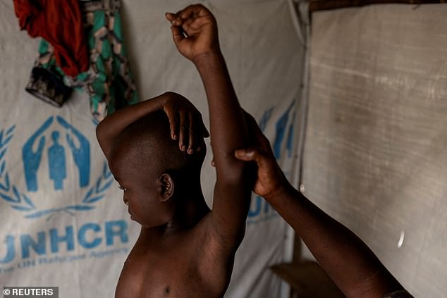 Fideline Kiza Kasao checks the progress of her son Kito Balume after recovering from Mpox