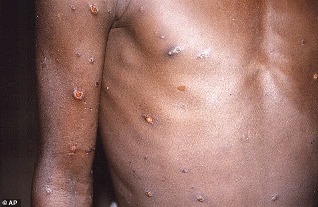 Symptoms of mpox shown on a patient in 1997, as provided by the CDC