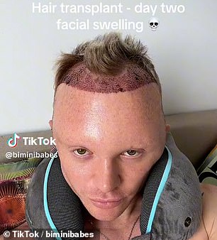 Bimini posted on TikTok saying the facial swelling was ' natural part of the healing process'...