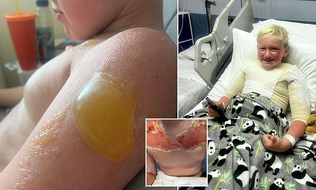 Horrifying images show danger of buying sun cream abroad - as 10 year-old is hospitalised