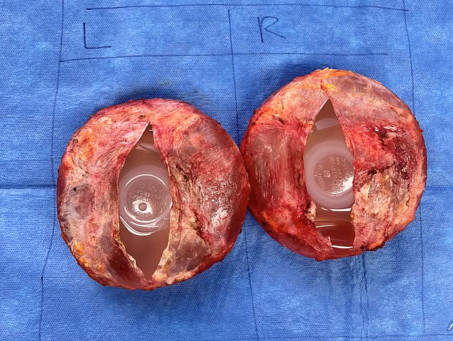 Holly's surgeon photographed her breast implants after they were removed to ensure they had a record of the make and serial number