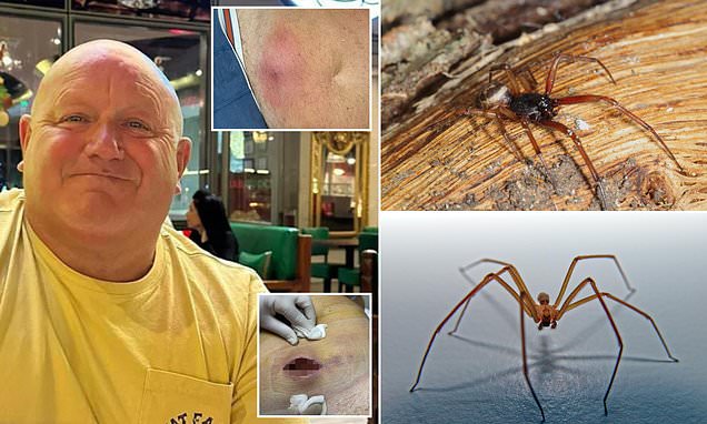 Father of three, 59, develops gruesome flesh-eating from a tiny spider bite that grew into