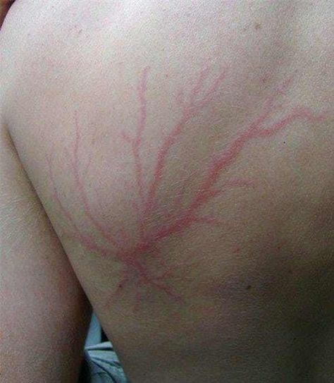 Classic Web-Like Pattern From is listed (or ranked) 7 on the list These Photos Show What Happens After You Get Struck By Lightning Human Body, Struck By Lightning Scar, Lightning Scar, Lightning Photos, Lichtenberg Figures, Struck By Lightning, Lightning Strikes, Maple Leaf Tattoo, Triangle Tattoo