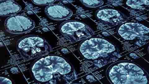 Magnetic resonance imaging