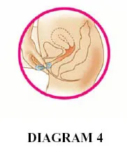  Use your index finger to push the ring as far as you can into your vagina - Illustration