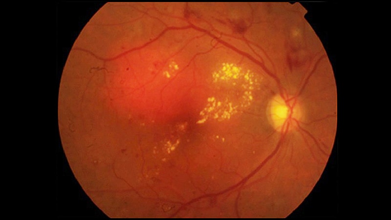 Biosimilar Matches Aflibercept for Diabetic Macular Edema