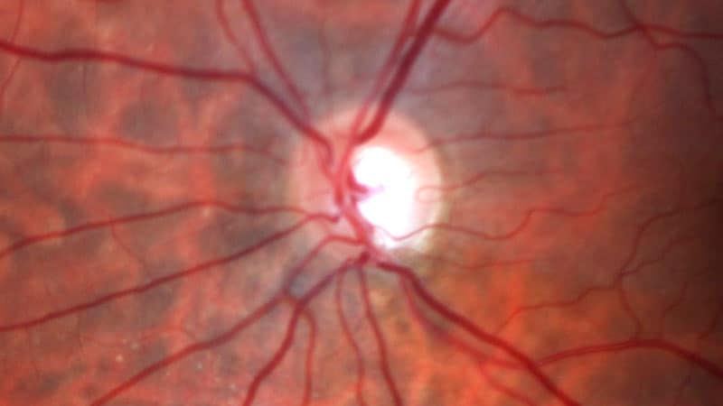 Early Glaucoma Doesn't Impair Vision-Related Quality of Life