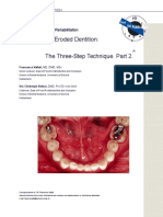 Full Mouth Adhesive Rehabilitation. The Three Stpe Techinique Part 2