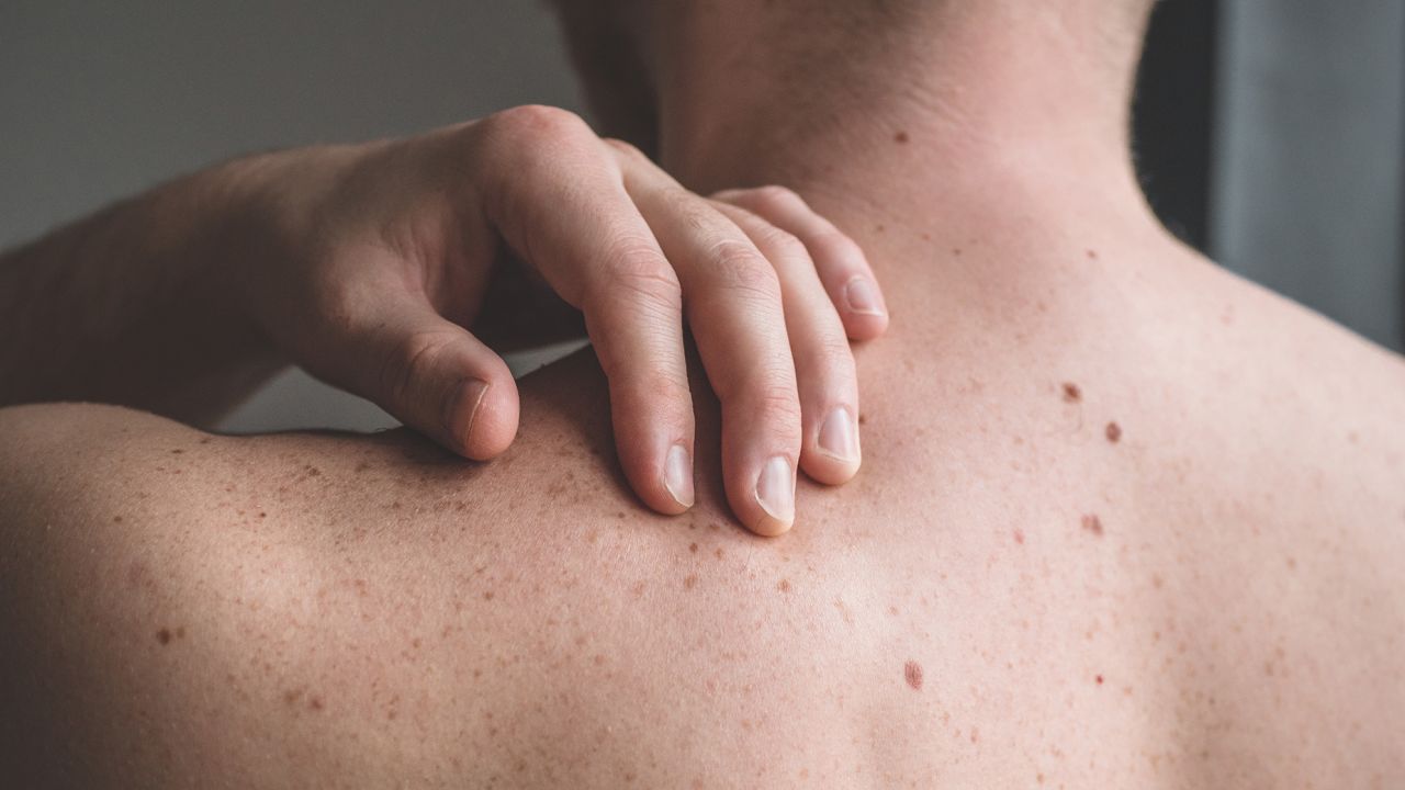 Checking benign moles. Close up detail of the bare skin on a man back with scattered moles and freckles. Sun effect on skin. Birthmarks on skin