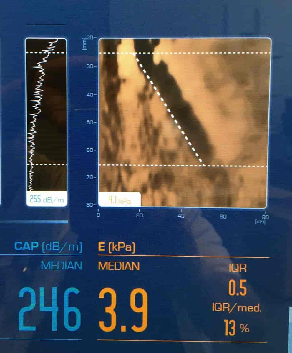 Normal fibroelastografi af leveren