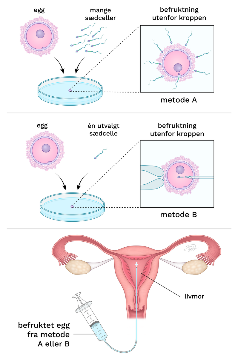 IVF og ICSI