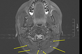 An MRI image from the author pointing out tiny lesion spots in her brain from Multiple Sclerosis with yellow arrows.