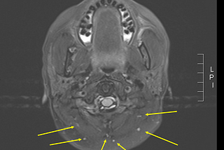 An MRI image from the author pointing out tiny lesion spots in her brain from Multiple Sclerosis with yellow arrows.