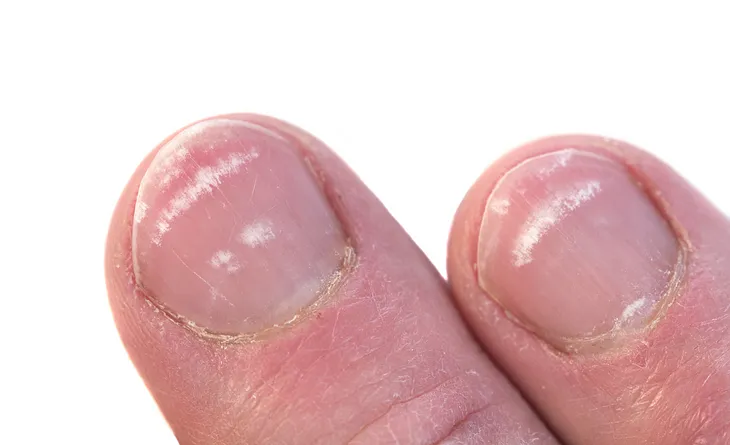 The Many Surprising Things Your Fingernails Can Tell You