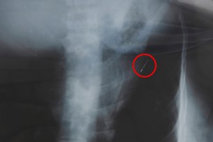 A dental drill bit clearly visible in an x-ray of Don Liyanage's chest.