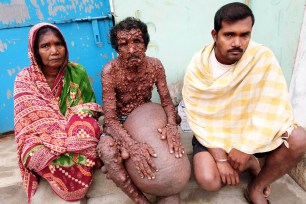 Diwakar Bisoye, 65, from Odisha State, India, nicknamed the "Bubble Skin Man".