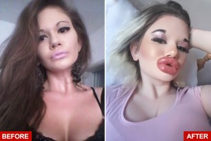 Andrea Ivanova, a Bulgarian woman with the "biggest lips in the world," is undergoing her 27th procedure to make her pout even bigger. She is pictured before and after her injections.