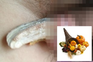 A Chinese man had a 2-inch horn removed from his penis.