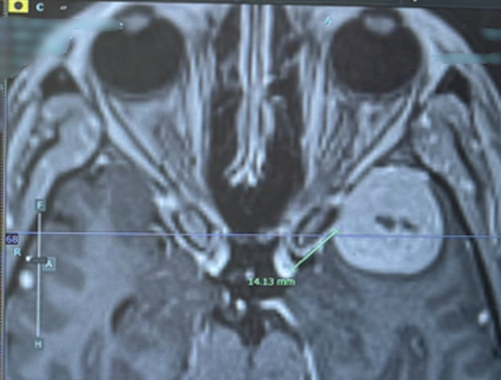 xray of brain tumor