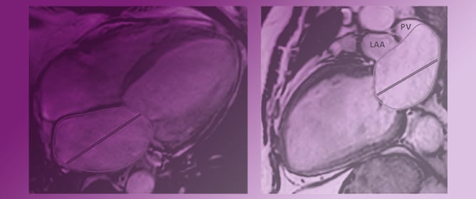 Improved Interpretation of Pulmonary Artery Wedge Pressures through Left Atrial Volumetry&mdash;A Cardiac Magnetic Resonance Imaging Study