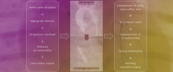 Balloon Valvuloplasty in Congenital Critical Aortic Valve Stenosis in Neonates and Infants: A Rescue Procedure for the Left Ventricle