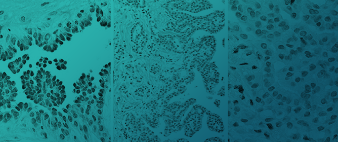 BAP1 Loss, Nuclear Grading, and Nonepithelioid Features in the Diagnosis of Mesothelioma in Italy: Nevermore without the Pathology Report