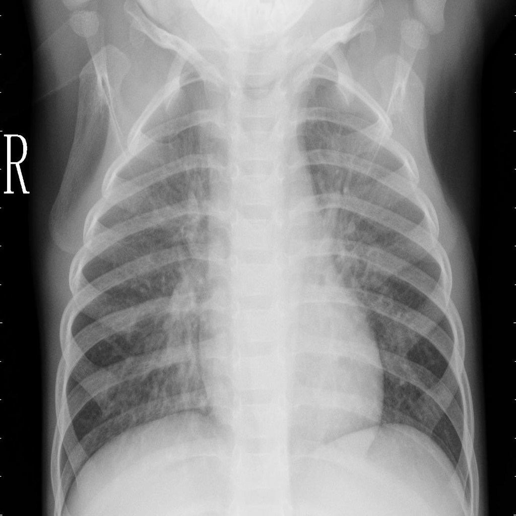 Covid-19-chest-x_rays-images-multi-class-classification-computer-vision-