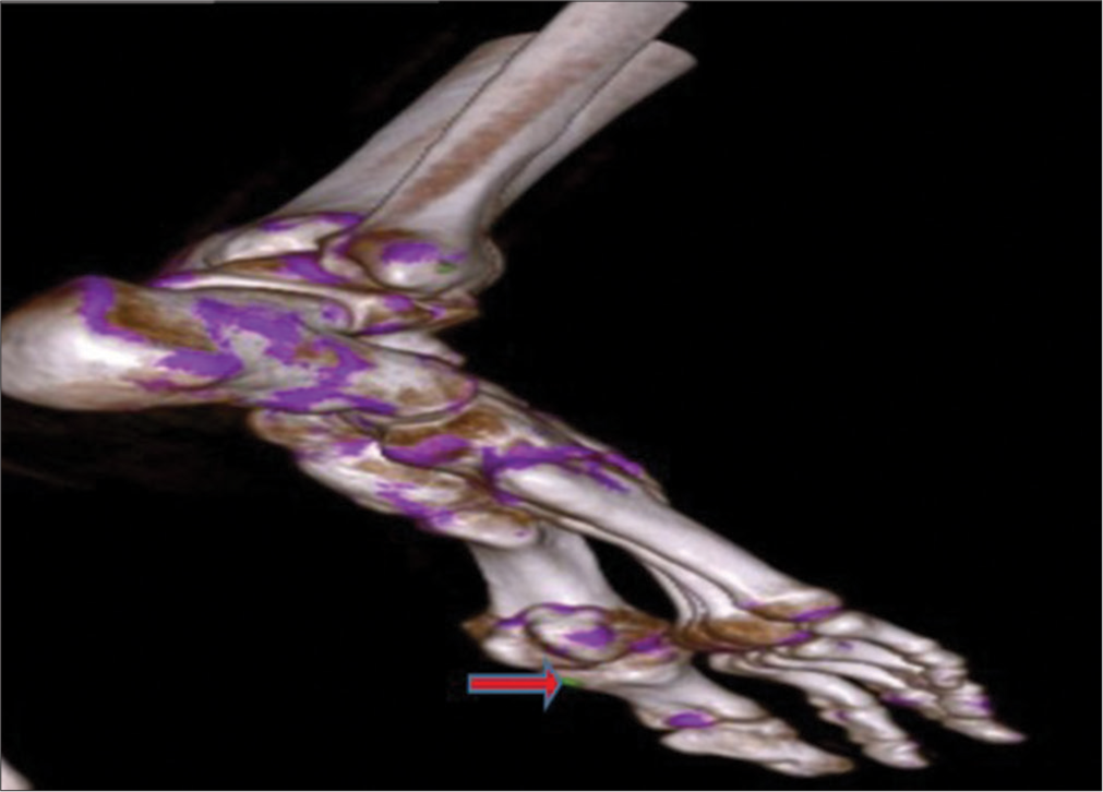 Comparison between dual-energy computed tomography and ultrasound in the diagnosis of gout