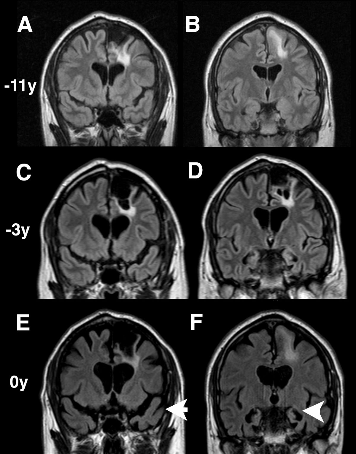 MR showing progressive anterior and mesial temporal lobe atrophy