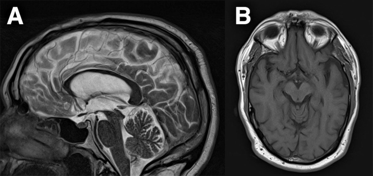 MR showing No midbrain atrophy or hummingbird sign