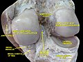 Right knee in extension. Dərin parçalanma. Arxa görünüş.