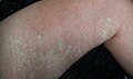 Nevus anemicus