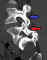 Spondylolisthesis L5/S1. Blue arrow normal pars interarticularis. Red arrow is a break in pars interarticularis