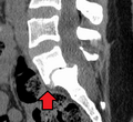 Spondylolisthesis L5/S1