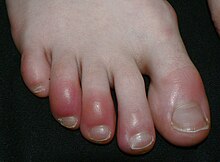 Redness and swelling of the distal toes