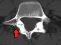 Spondylolisthesis L5/S1