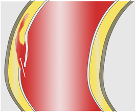 Aortadissectie