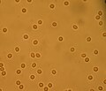 Microhaematuria