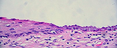 The squamocolumnar junction of the cervix, with abrupt transition: The ectocervix, with its stratified squamous epithelium, is visible on the left. Simple columnar epithelium, typical of the endocervix, is visible on the right. A layer of connective tissue is visible under both types of epithelium.