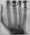 File:Die Gartenlaube (1896) b 0116_a_2.jpg Hand mit darinsitzender Kugel Nach dem Roentgenschen Verfahren aufgenommen im physikalischen Institut des Großh. Neuen Gymnasiums in Darmstadt