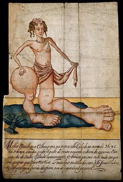 File:A woman with scales on her upper body and grossly enlarged l Wellcome V0007397.jpg