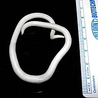 AscariasisAscaris lumbricoides