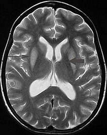 Extrapontine myelinolysis T2 01.jpg