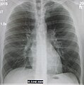 Normal AP CXR